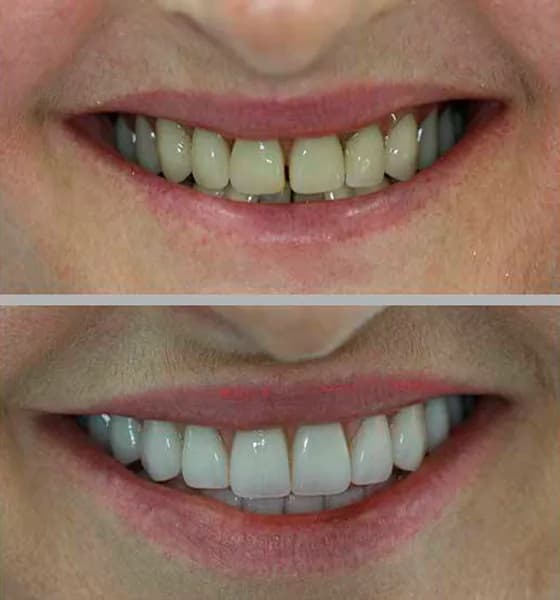 Protese dentadura 01 na Clínica Odontológica Menegotto