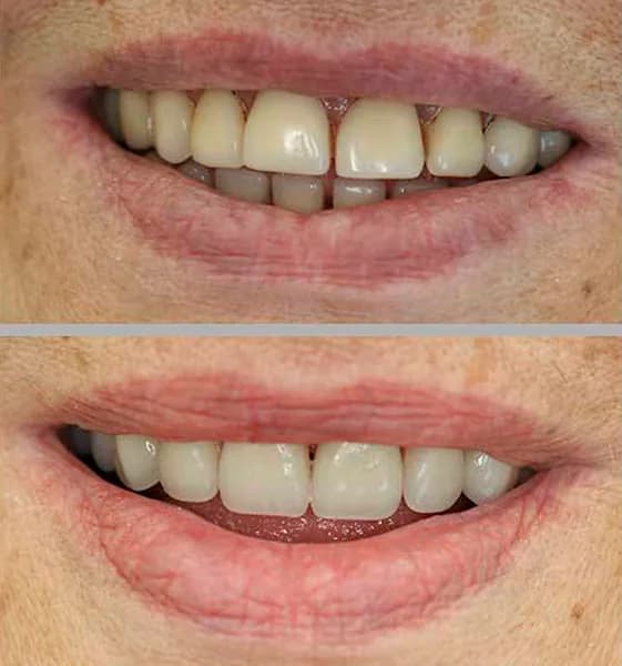 Protese dentadura 02 na Clínica Odontológica Menegotto