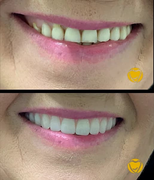 Protese dentadura 03 na Clínica Odontológica Menegotto
