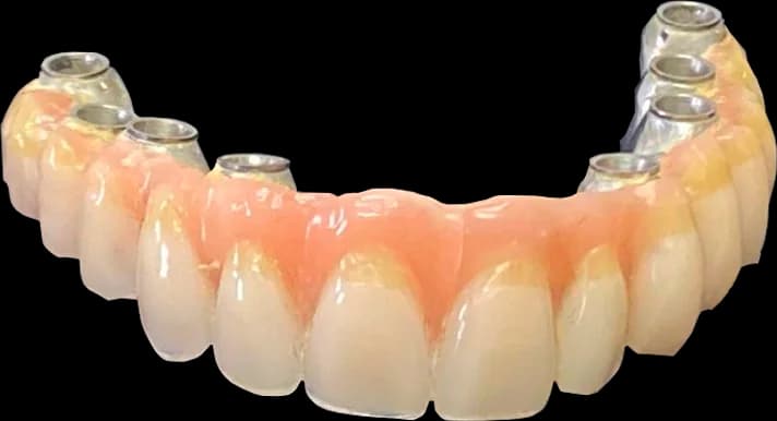 Protese protocolo clinicamenegotto 02 na Clínica Odontológica Menegotto
