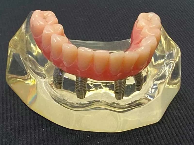 Protese protocolo clinicamenegotto 03 na Clínica Odontológica Menegotto