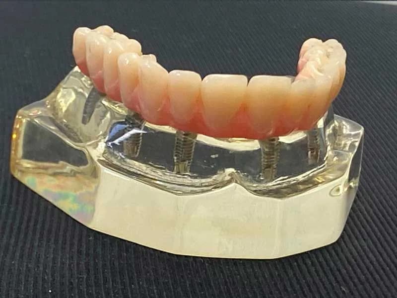 Protese protocolo clinicamenegotto 04 na Clínica Odontológica Menegotto