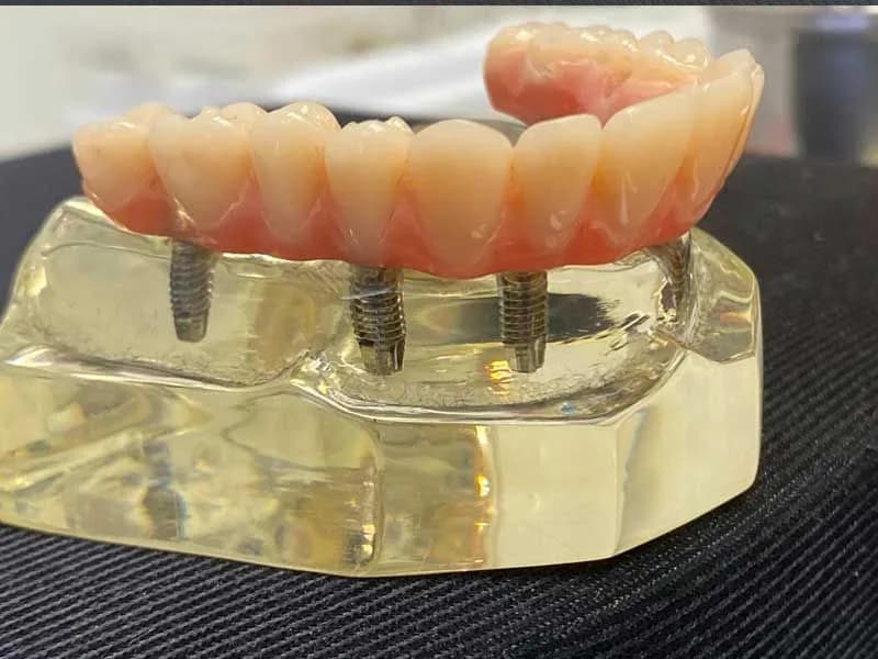 Prótese protocolo montada sobre modelo, na bancada