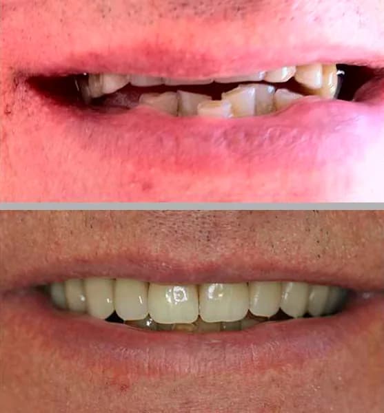 Prótese Protocolo: comparação de antes e depois do tratamento