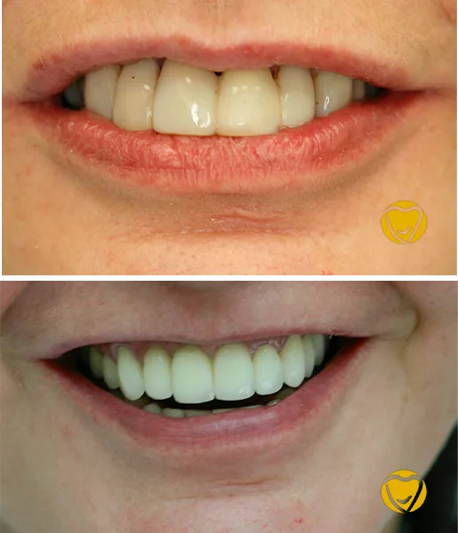 Prótese Protocolo: comparação de antes e depois do tratamento