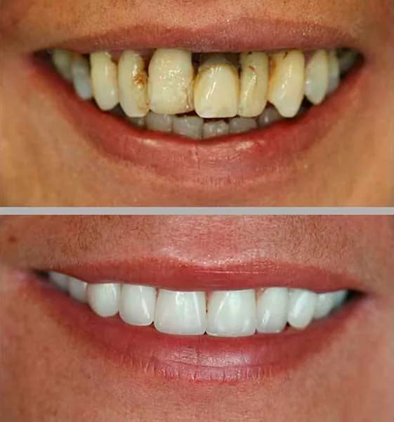 Prótese Protocolo: comparação de antes e depois do tratamento