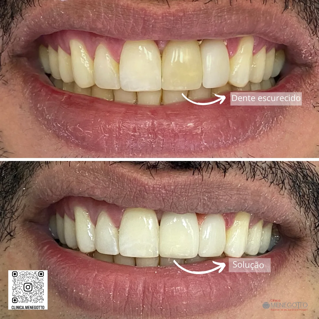 Clareamento dentário: comparação de antes e depois do tratamento