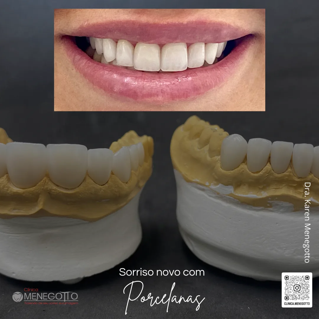 Sorriso novo com porcelanas: comparação de antes e depois do tratamento
