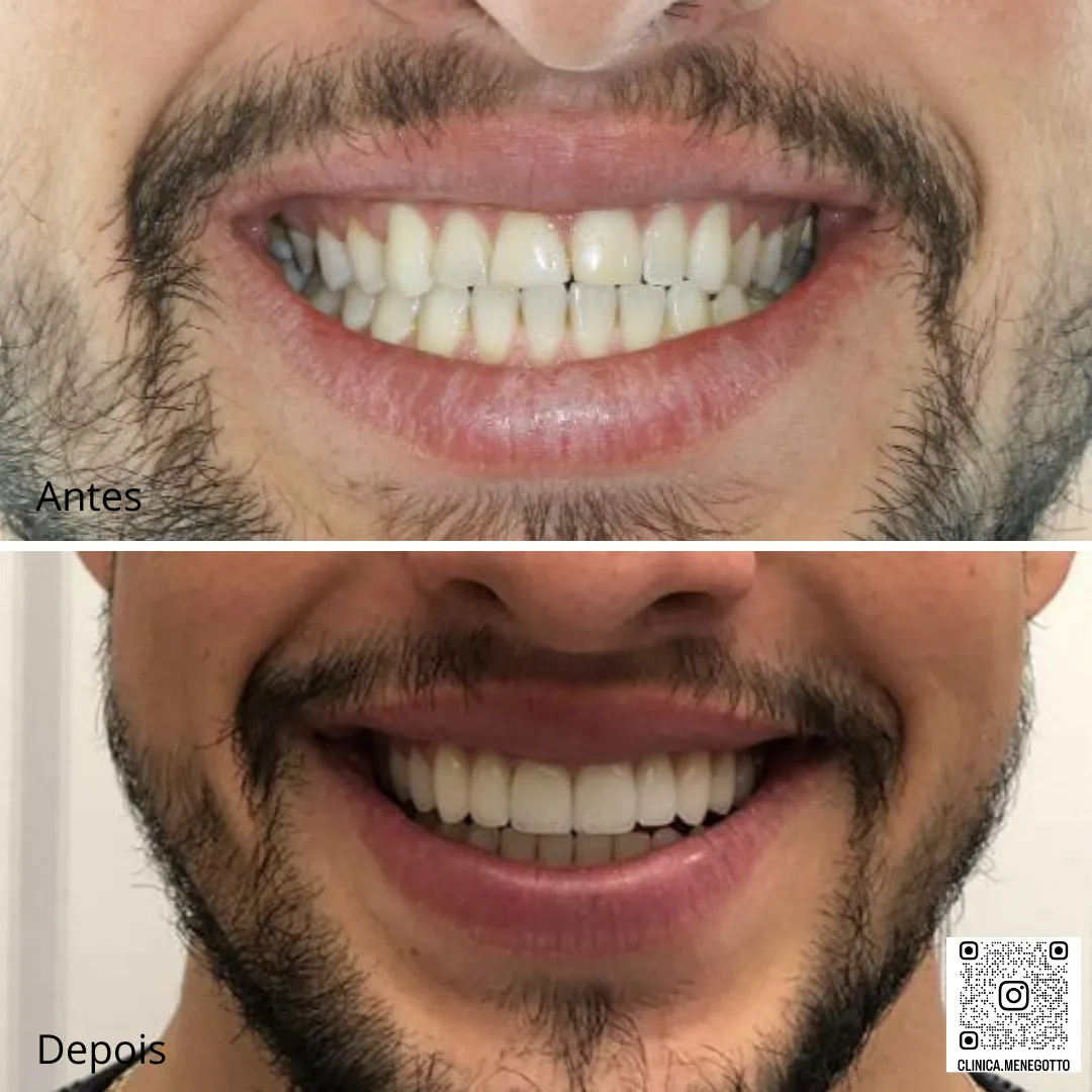 Facetas de porcelana: comparação de antes e depois do tratamento