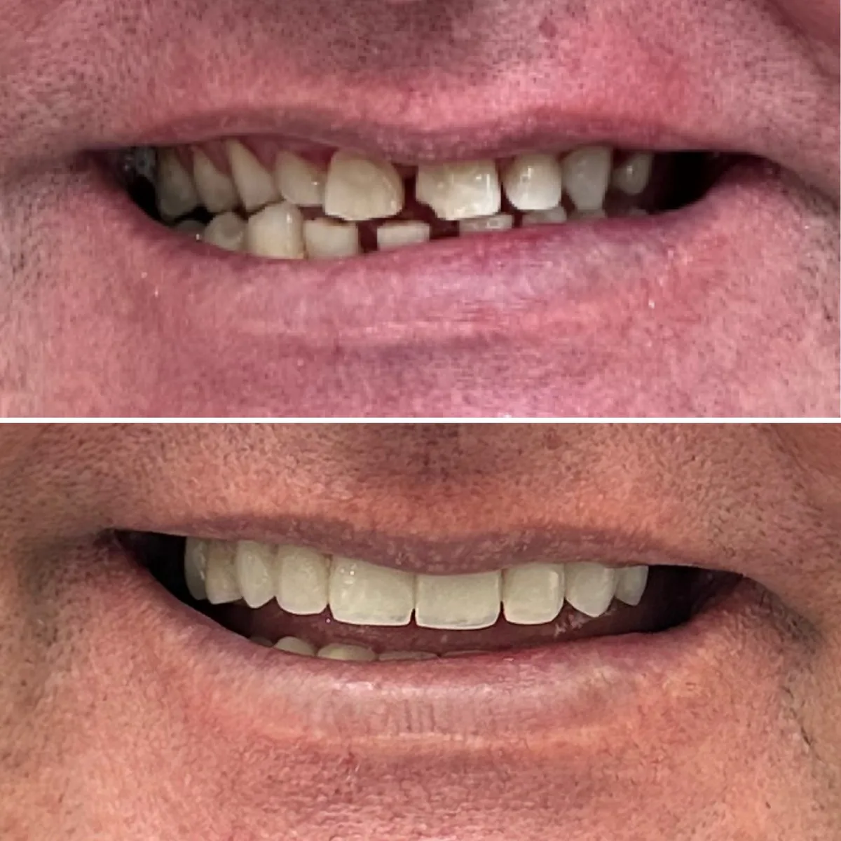 Facetas de porcelana: comparação de antes e depois do tratamento