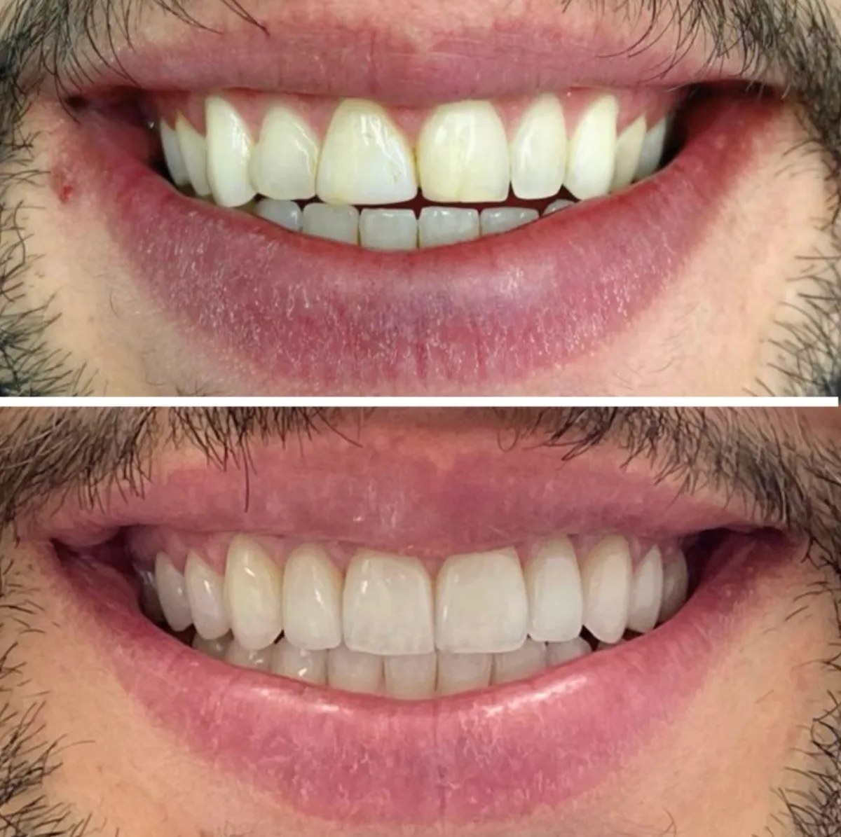 Facetas de porcelana: comparação de antes e depois do tratamento