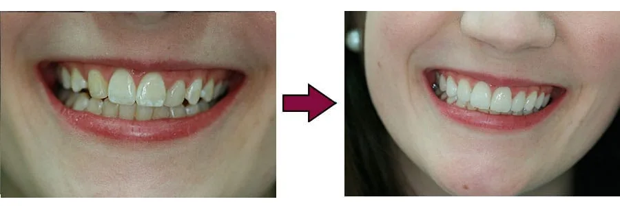 Facetas de porcelana: comparação de antes e depois do tratamento