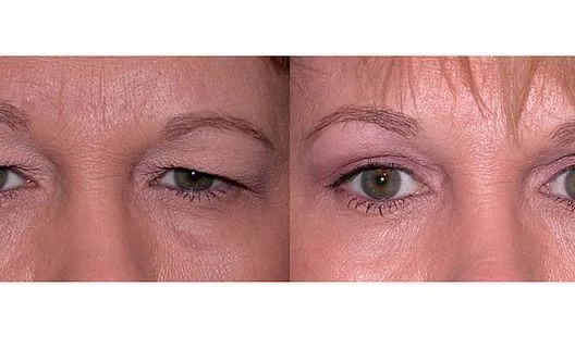 Jato de plasma: comparação de antes e depois do tratamento