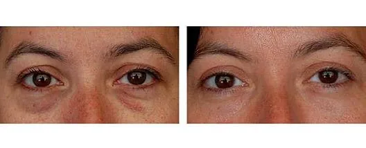Jato de plasma: comparação de antes e depois do tratamento