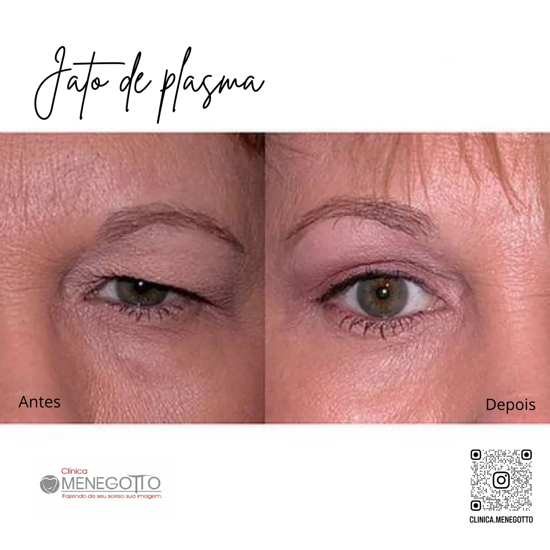 Jato de plasma: comparação de antes e depois do tratamento
