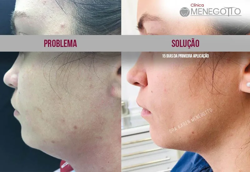 Remoção de papada: comparação de antes e depois do tratamento