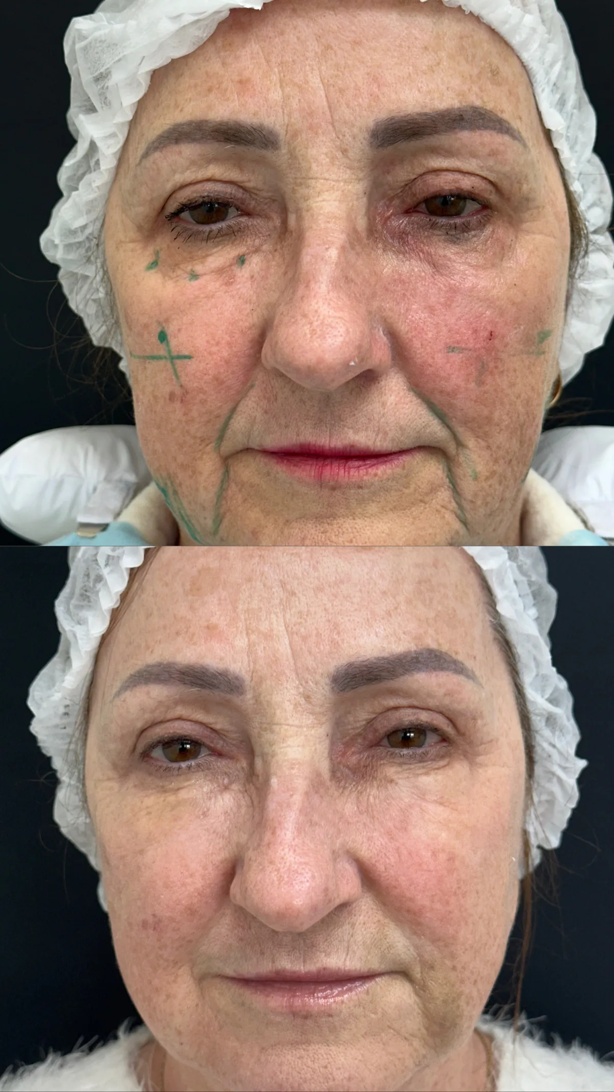 Preenchimento facial com ácido hialurônico: comparação de antes e depois do tratamento