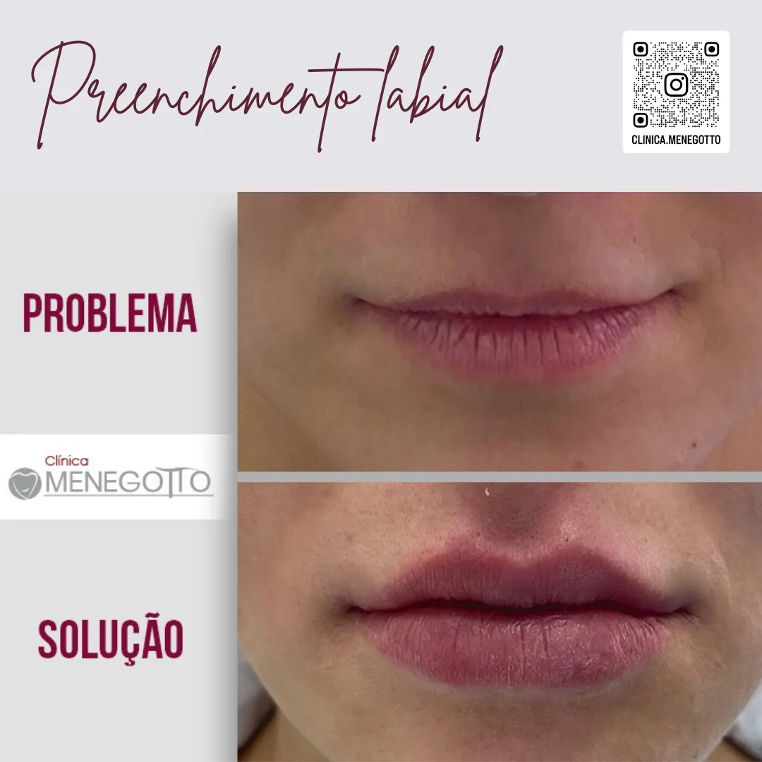 Preenchimento labial: comparação de antes e depois do tratamento