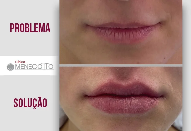 Preenchimento labial: comparação de antes e depois do tratamento