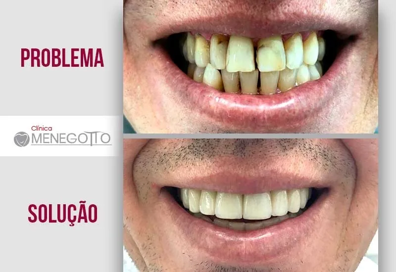 Prótese de porcelana sobre dente: comparação de antes e depois do tratamento