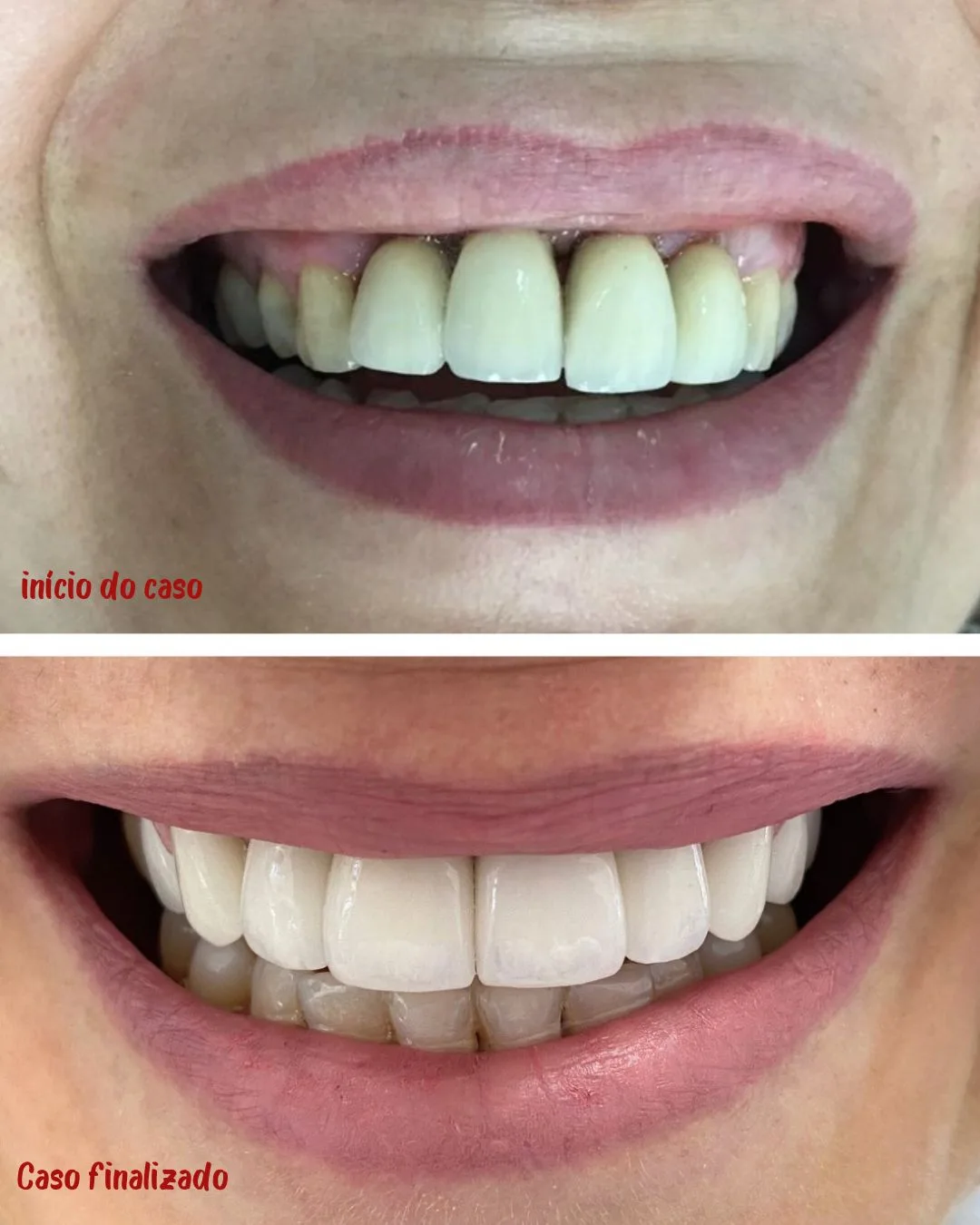 Prótese de porcelana sobre implante: comparação de antes e depois do tratamento