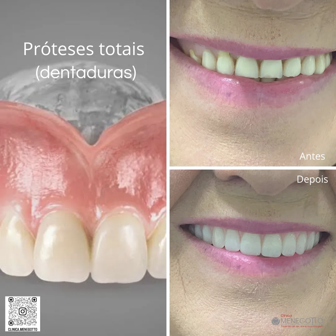 Próteses totais (dentaduras): comparação de antes e depois do tratamento