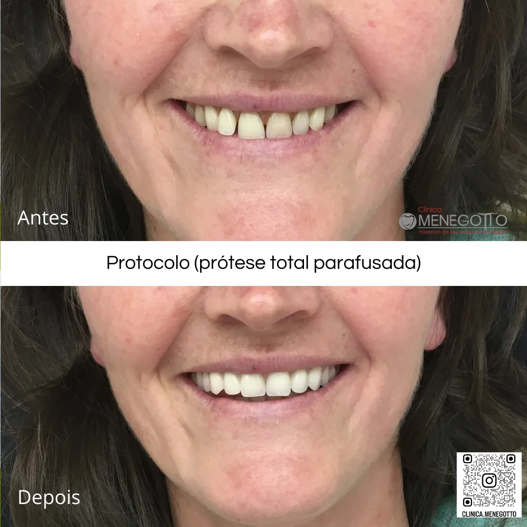 Protocolo (prótese total parafusada): comparação de antes e depois do tratamento