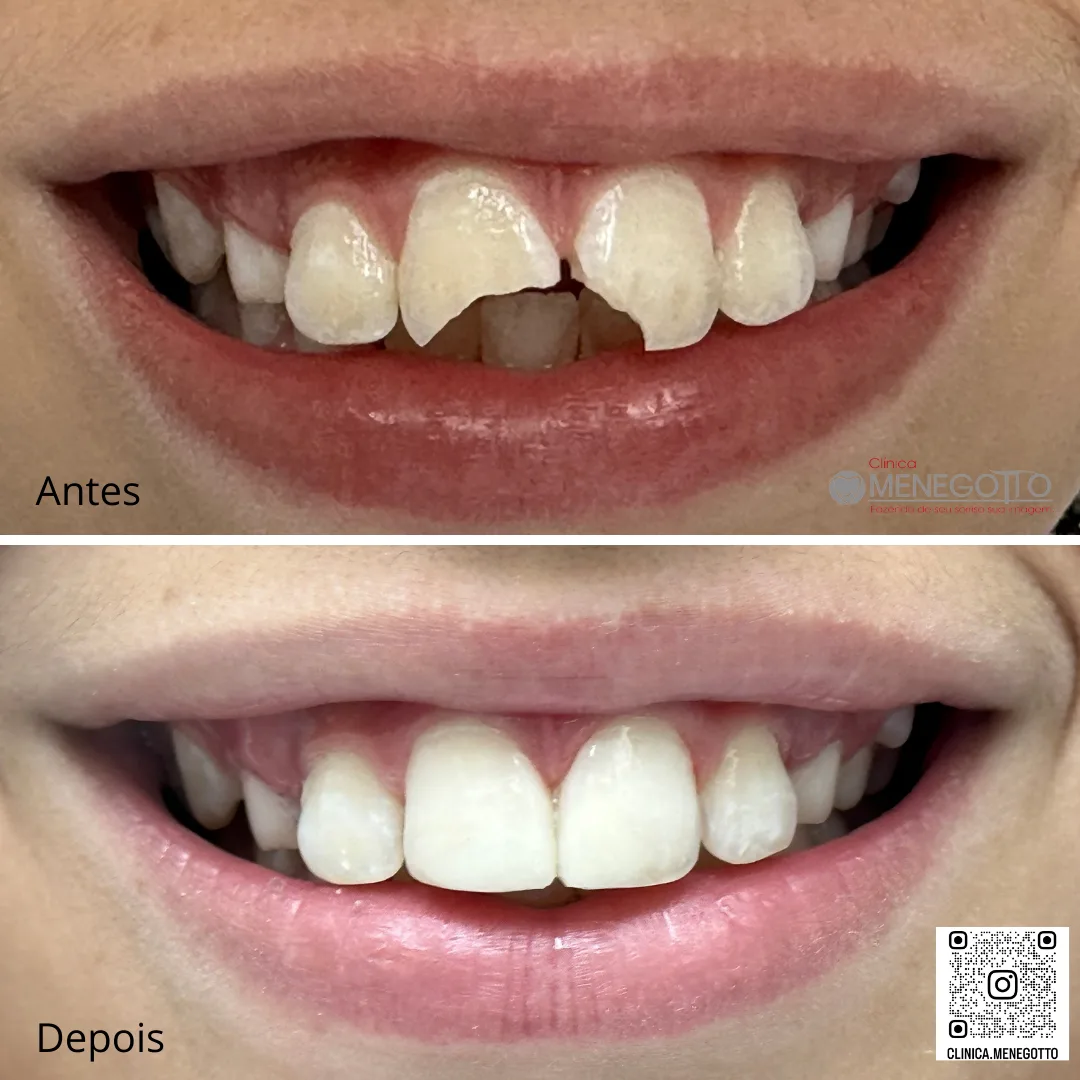 Restaurações estéticas: comparação de antes e depois do tratamento