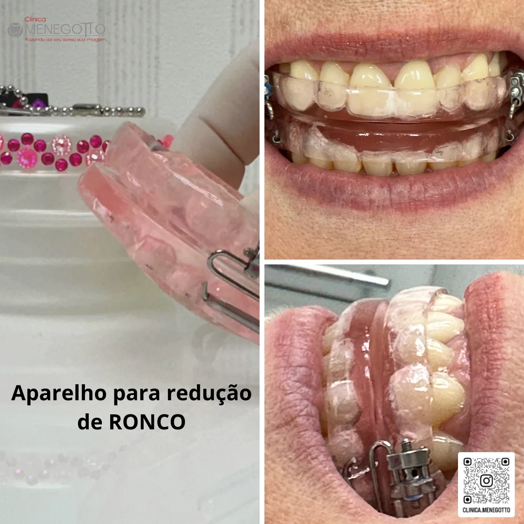 Aparelho para redução de ronco: comparação de antes e depois do tratamento