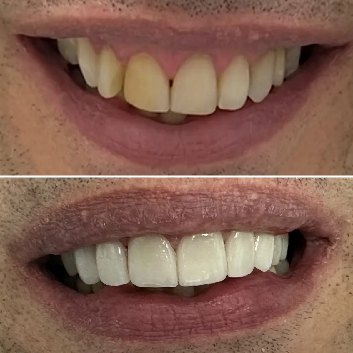 Reabilitação do sorriso: comparação de antes e depois do tratamento