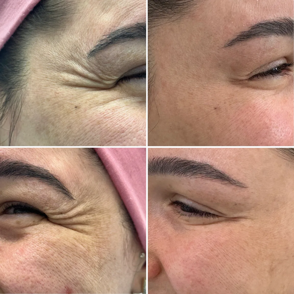 Harmonização facial: comparação de antes e depois do tratamento