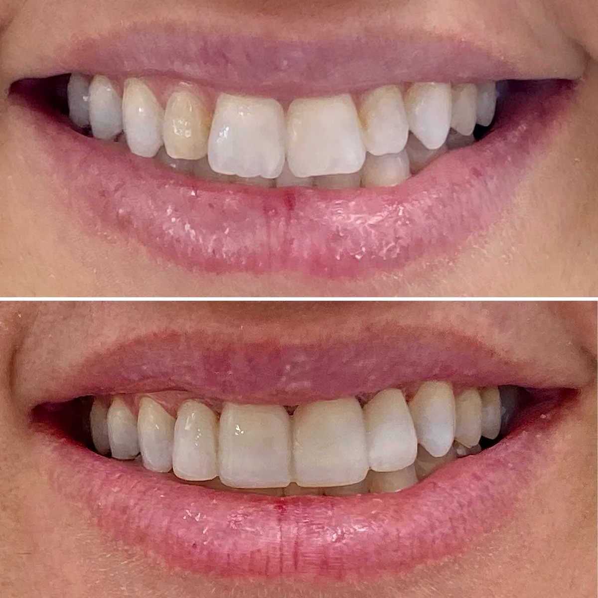 Reabilitação do sorriso: comparação de antes e depois do tratamento