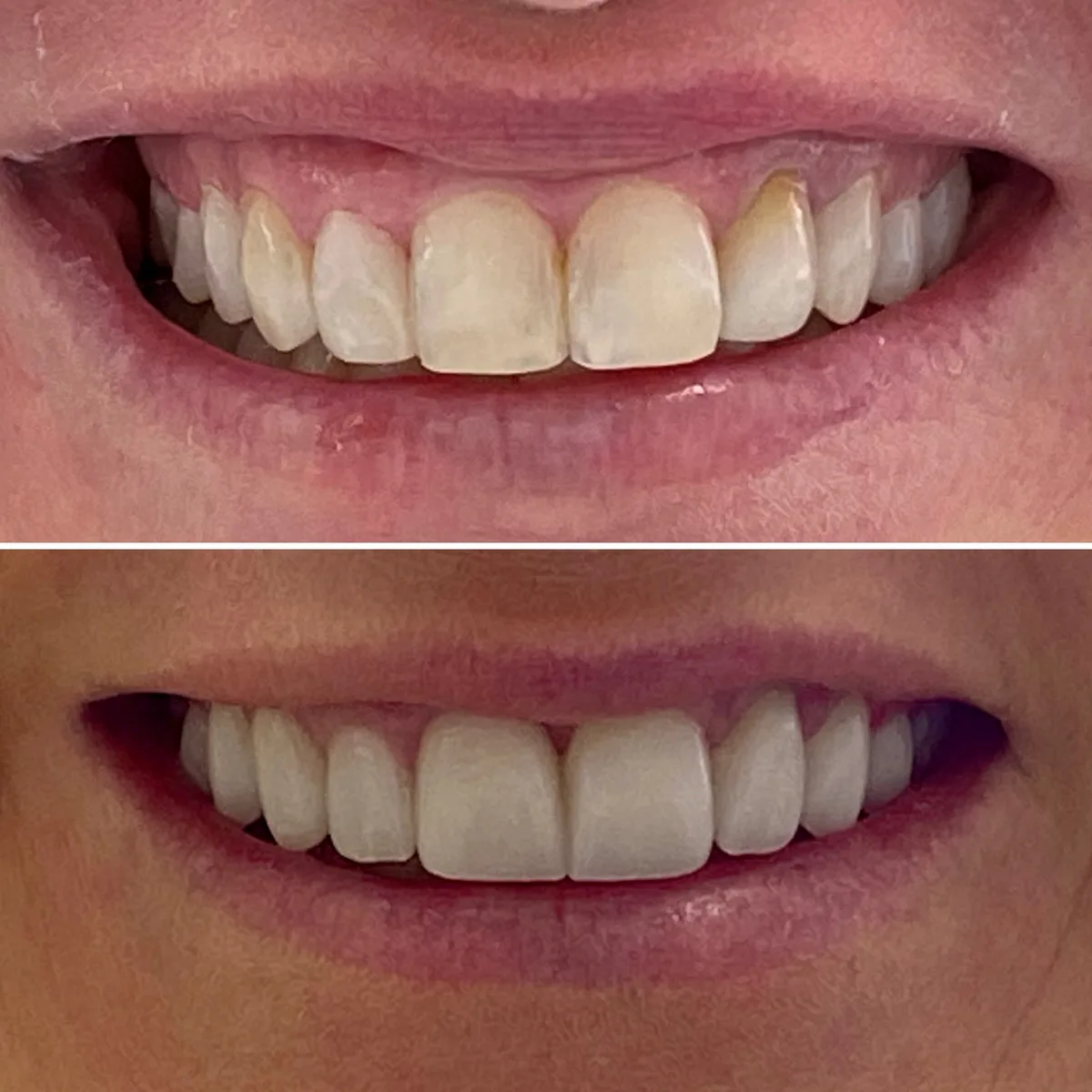 Reabilitação do sorriso: comparação de antes e depois do tratamento