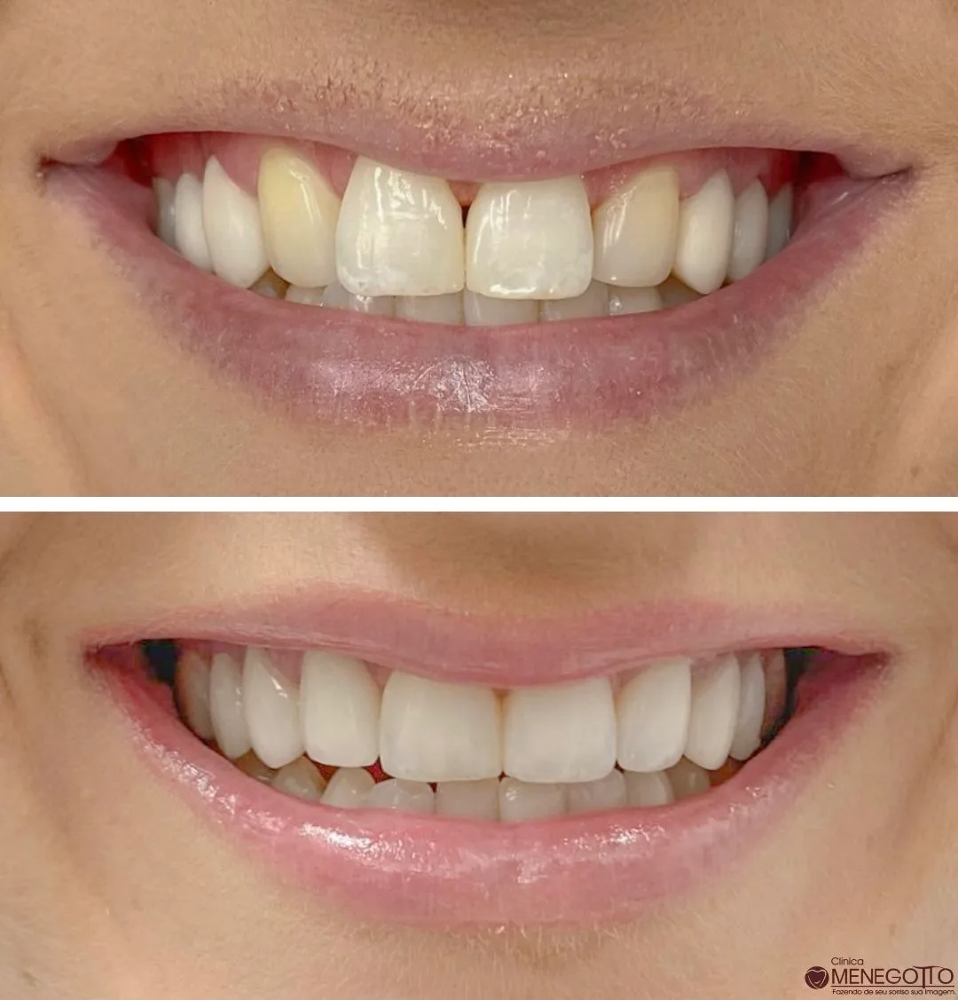 Reabilitação do sorriso: comparação de antes e depois do tratamento