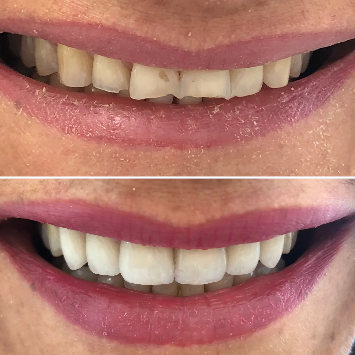 Reabilitação do sorriso: comparação de antes e depois do tratamento