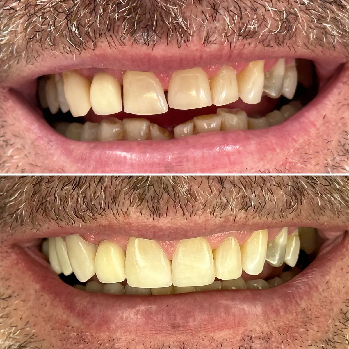 Reabilitação do sorriso: comparação de antes e depois do tratamento