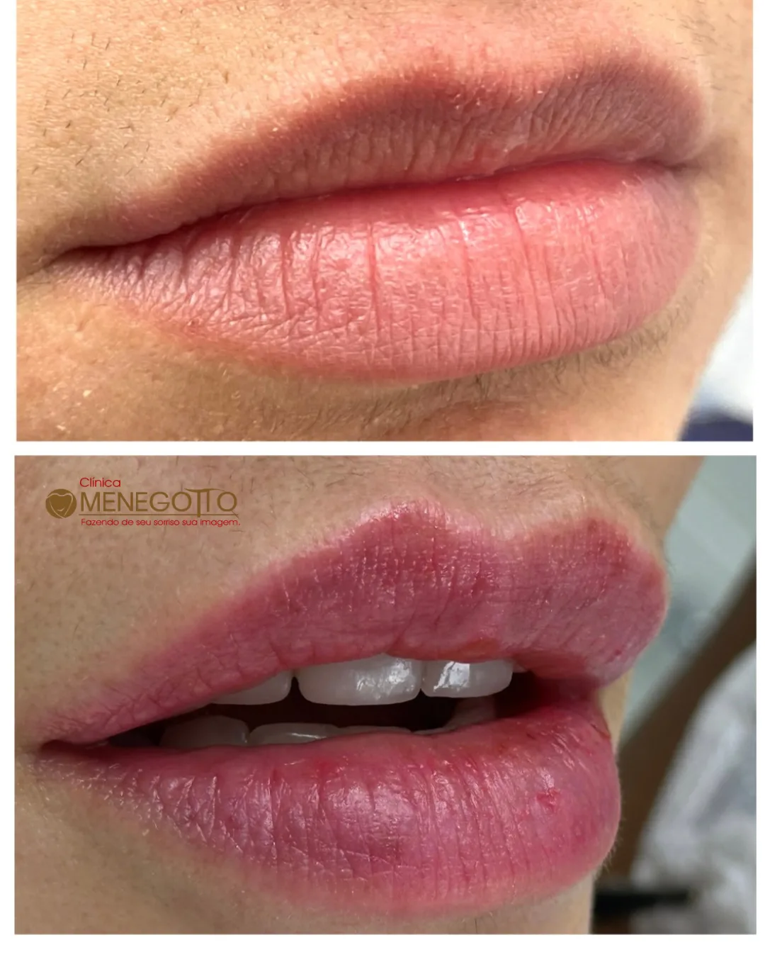 Preenchimento labial: comparação de antes e depois do tratamento