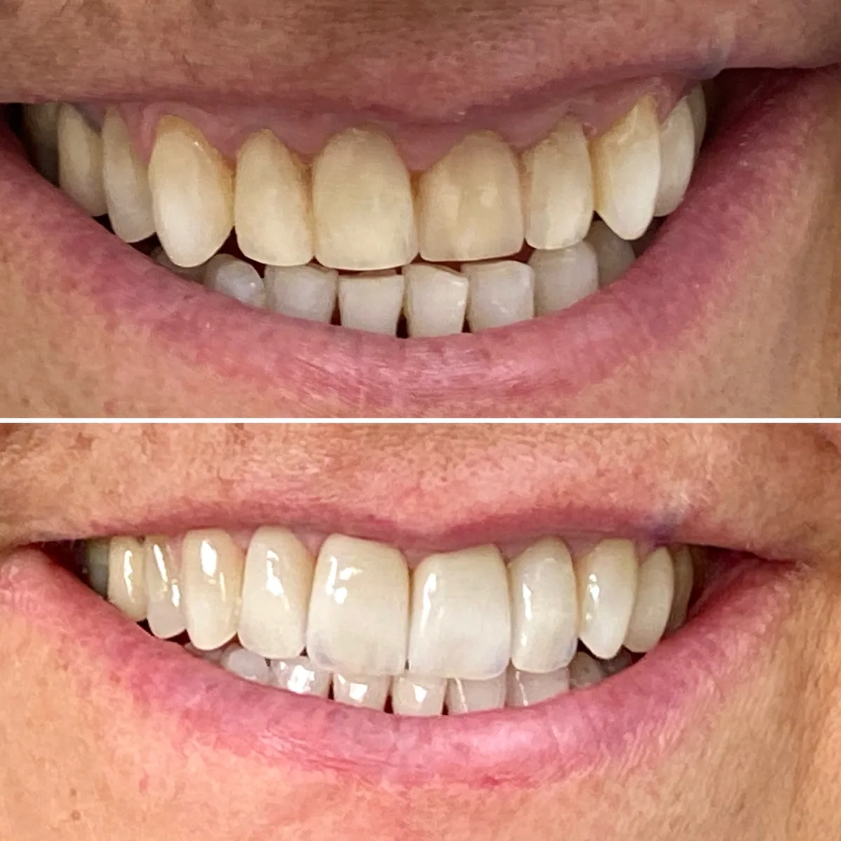 Reabilitação do sorriso: comparação de antes e depois do tratamento