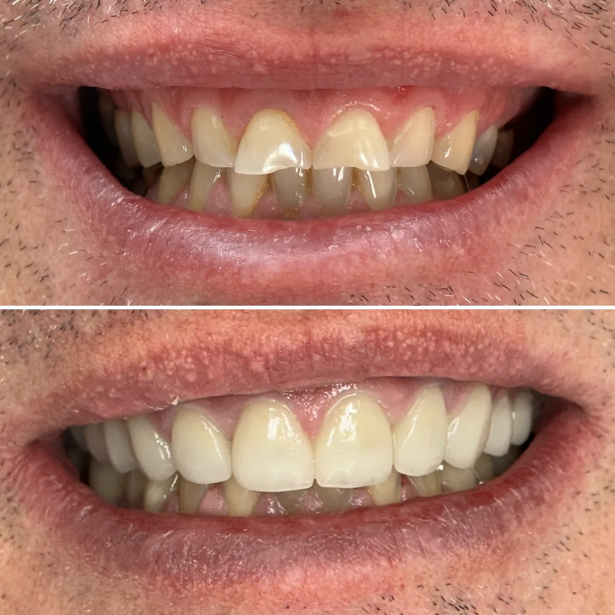 Reabilitação do sorriso: comparação de antes e depois do tratamento