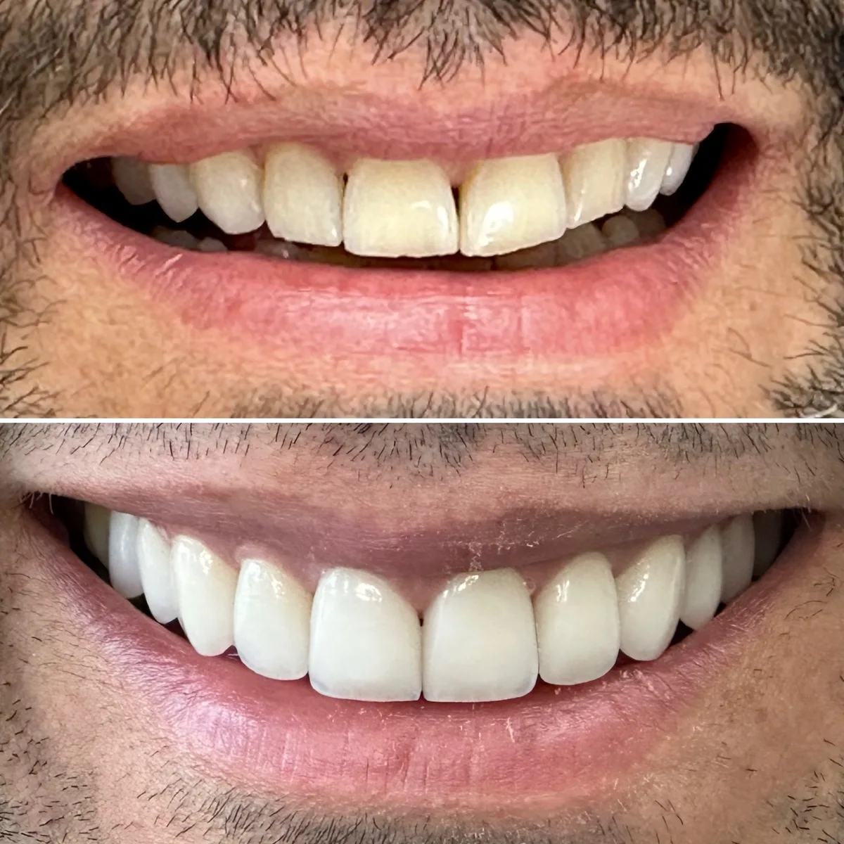 Reabilitação do sorriso: comparação de antes e depois do tratamento