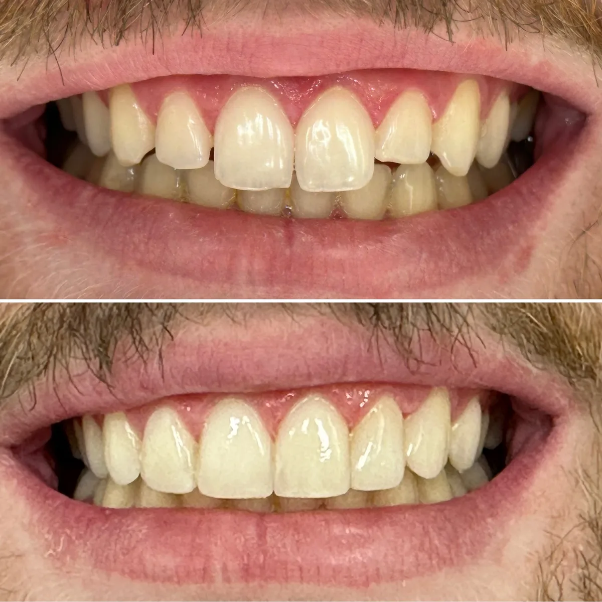 Reabilitação do sorriso: comparação de antes e depois do tratamento