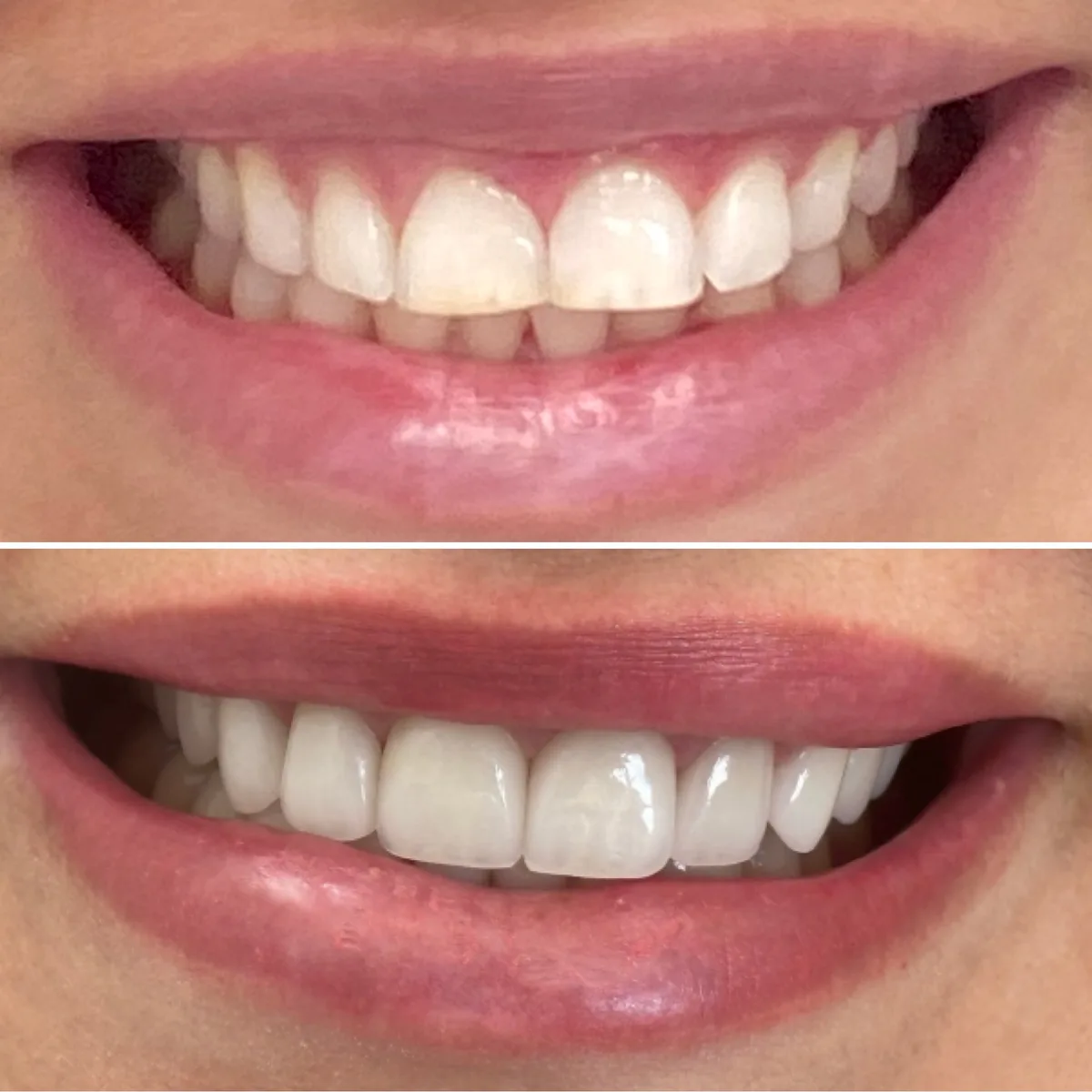 Reabilitação do sorriso: comparação de antes e depois do tratamento