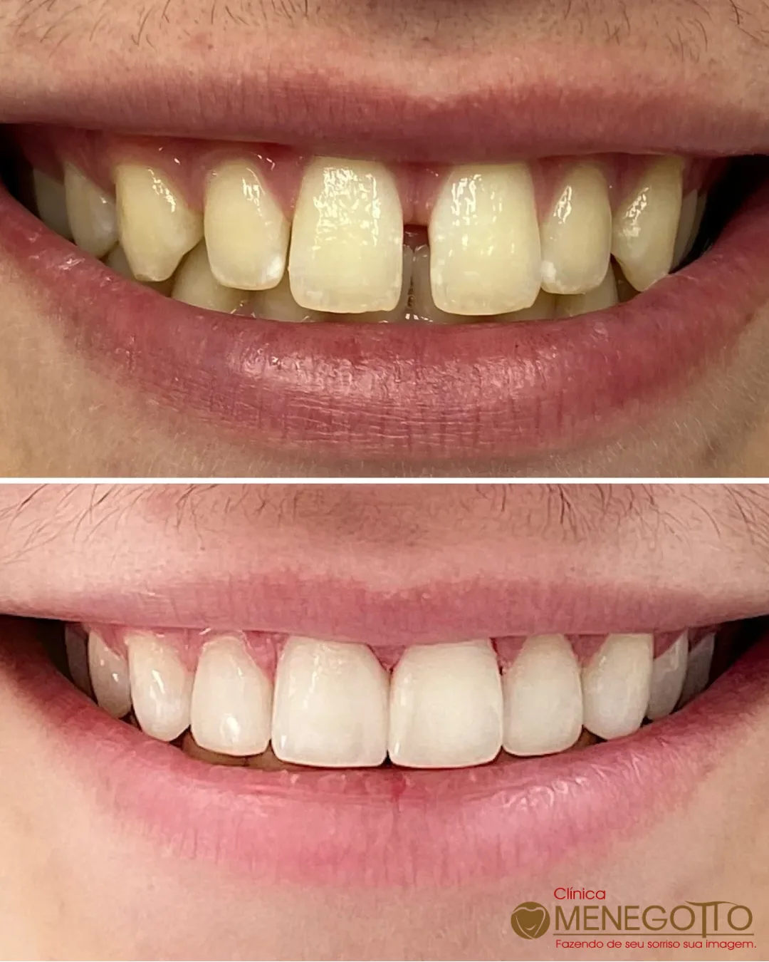 Reabilitação do sorriso: comparação de antes e depois do tratamento