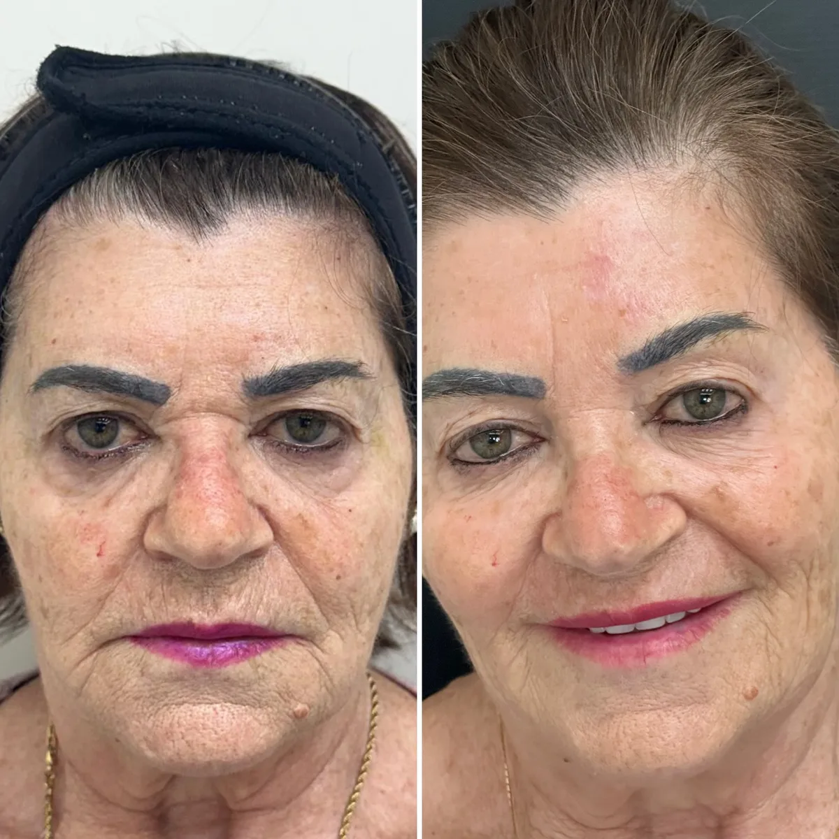 Harmonização facial: comparação de antes e depois do tratamento