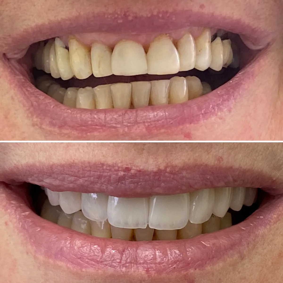 Reabilitação do sorriso: comparação de antes e depois do tratamento