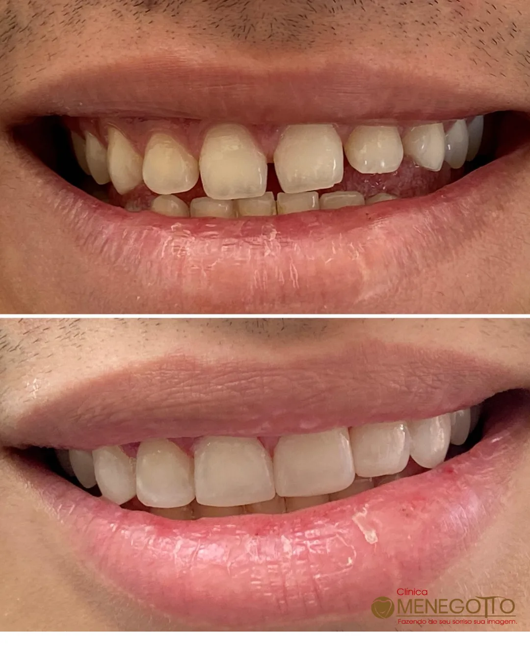 Reabilitação do sorriso: comparação de antes e depois do tratamento