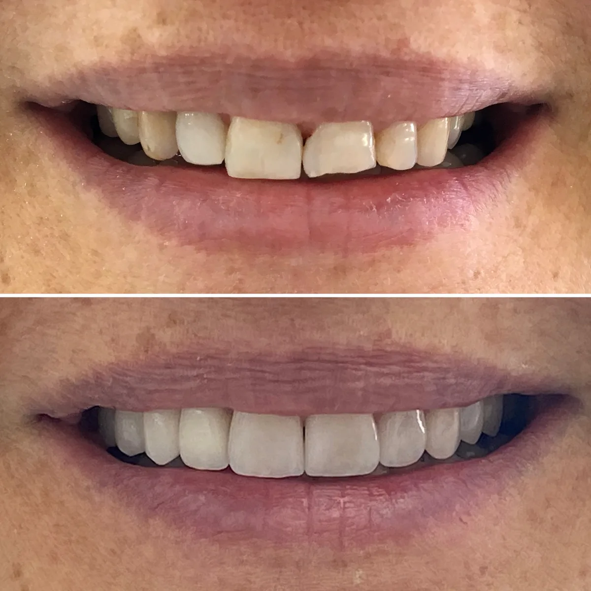 Reabilitação do sorriso: comparação de antes e depois do tratamento