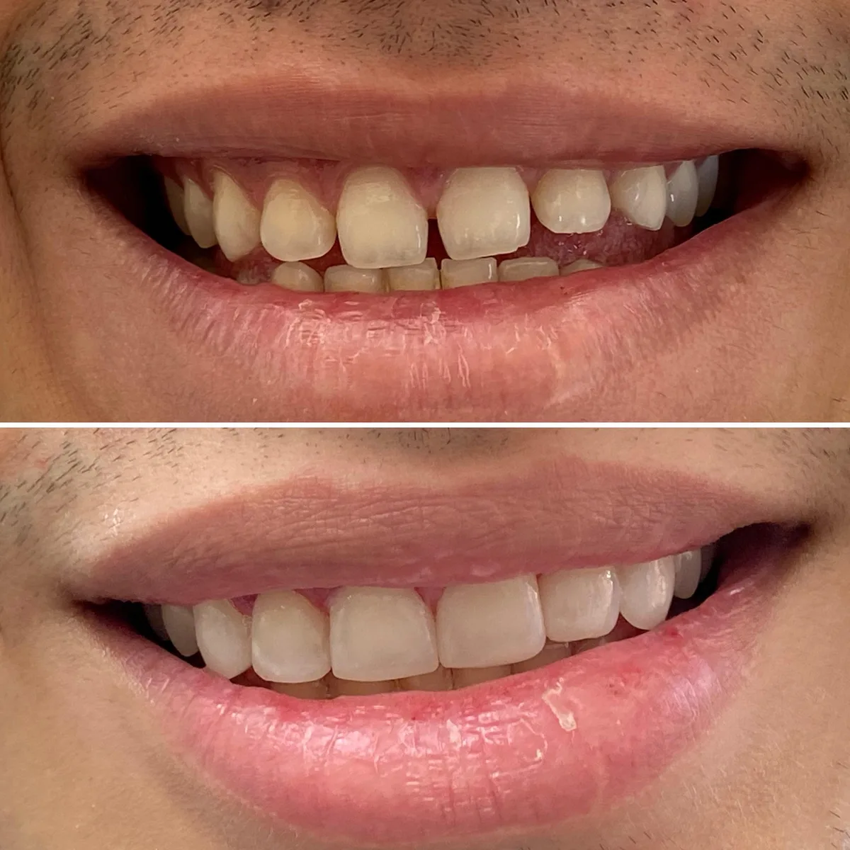 Reabilitação do sorriso: comparação de antes e depois do tratamento