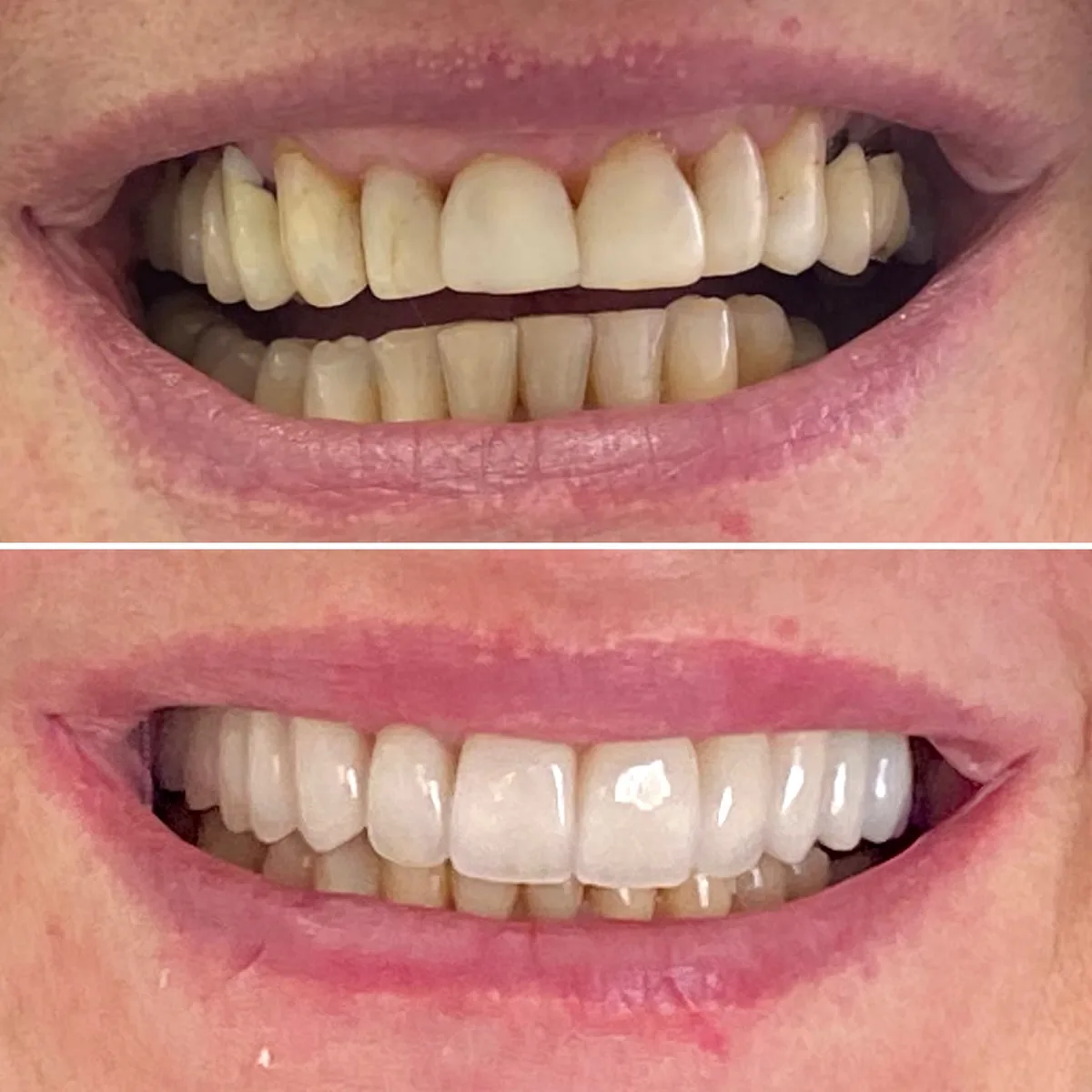 Reabilitação do sorriso: comparação de antes e depois do tratamento