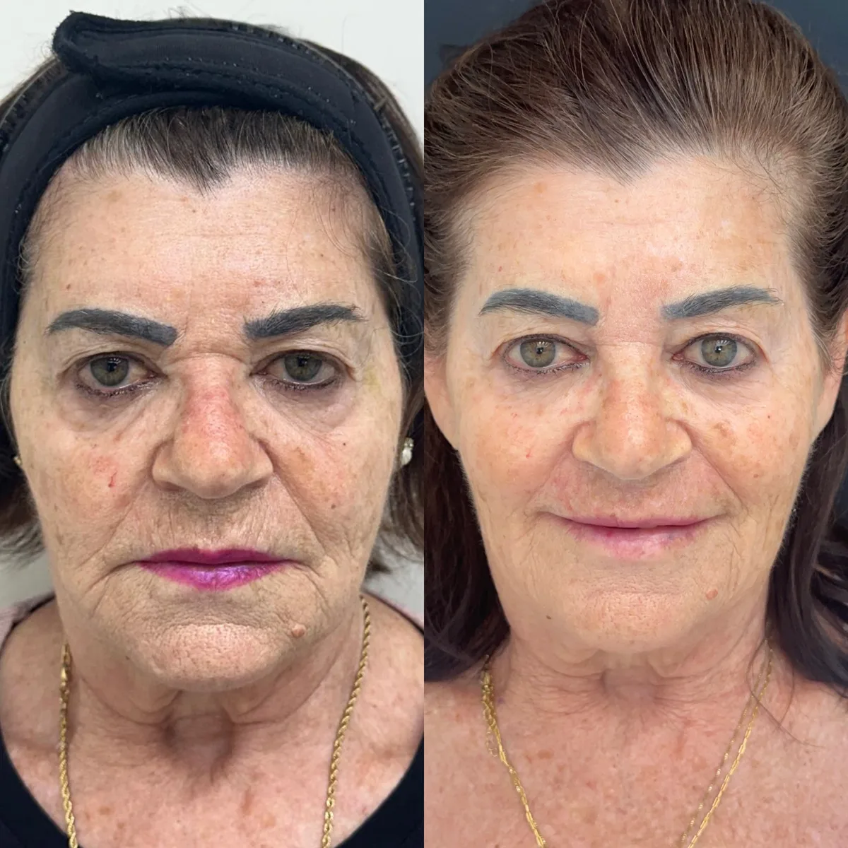 Harmonização facial: comparação de antes e depois do tratamento